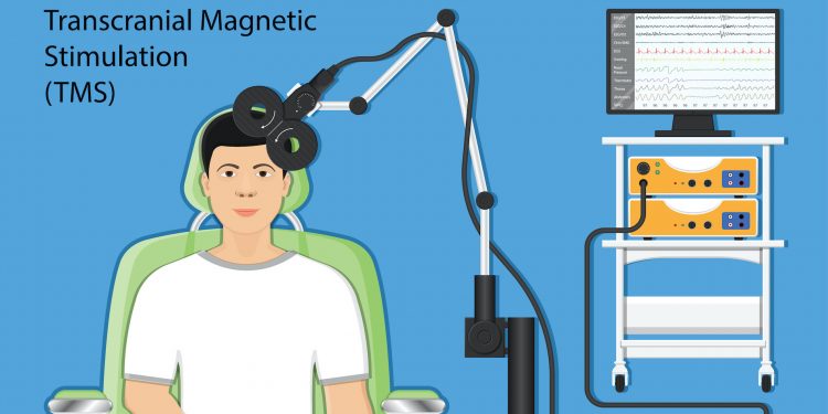 Transcranial Magnetic Stimulation